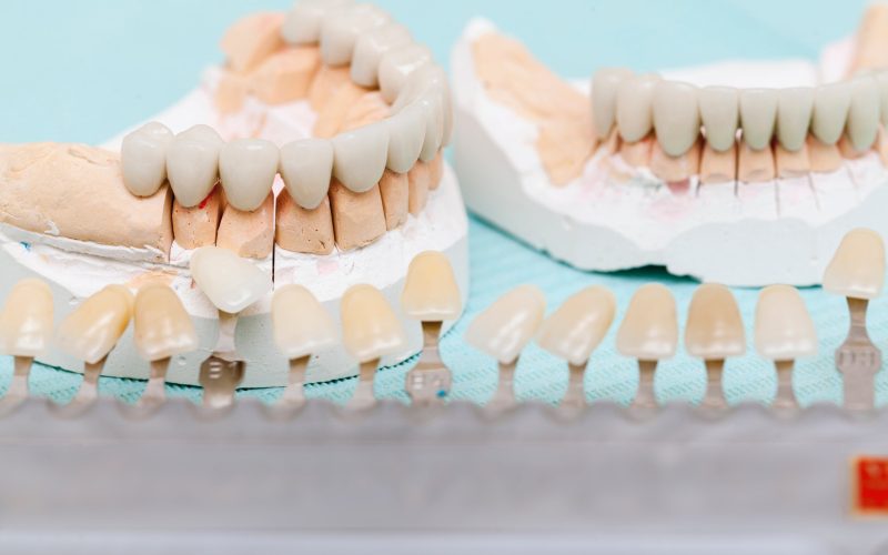 dental prostheses and ceramic covers for teeth